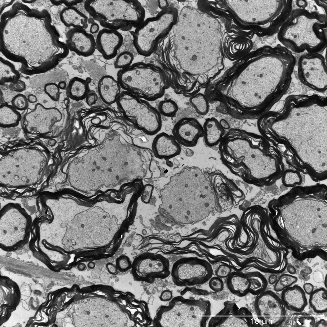 Bei Mäusen, denen Casein injiziert wurde, lockert sich die Struktur des Myelins auf. Es umhüllt die Axone nur noch lose. Manchmal fehlt die Isolierschicht sogar ganz.