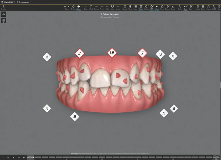 Therapie mit transparenten Zahnschienen: