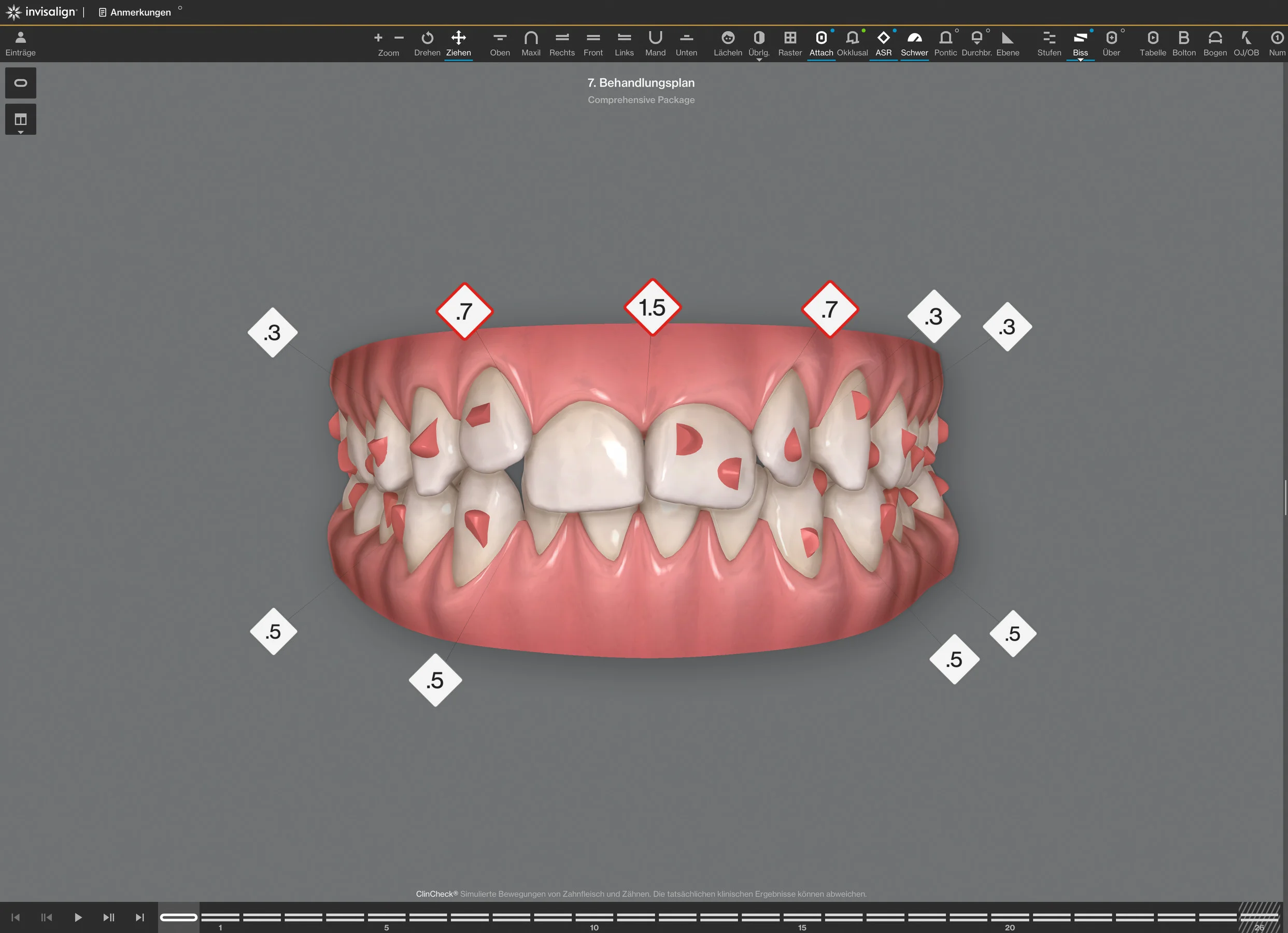 Therapie mit transparenten Zahnschienen: