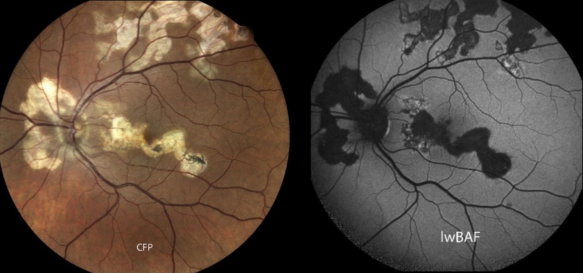 Das Bild zeigt ein von der seltenen serpiginösen Chorioretinopathie betroffenes Auge.