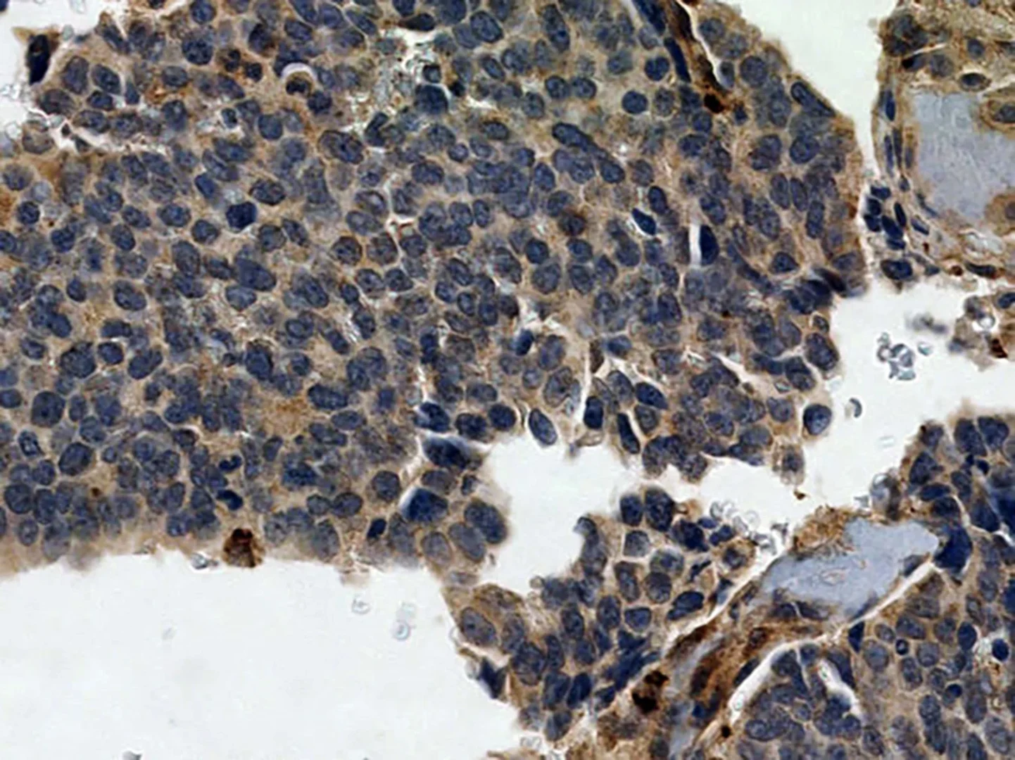 Auch hier erkennt man eine hohe Neuropilin-2-Expression
