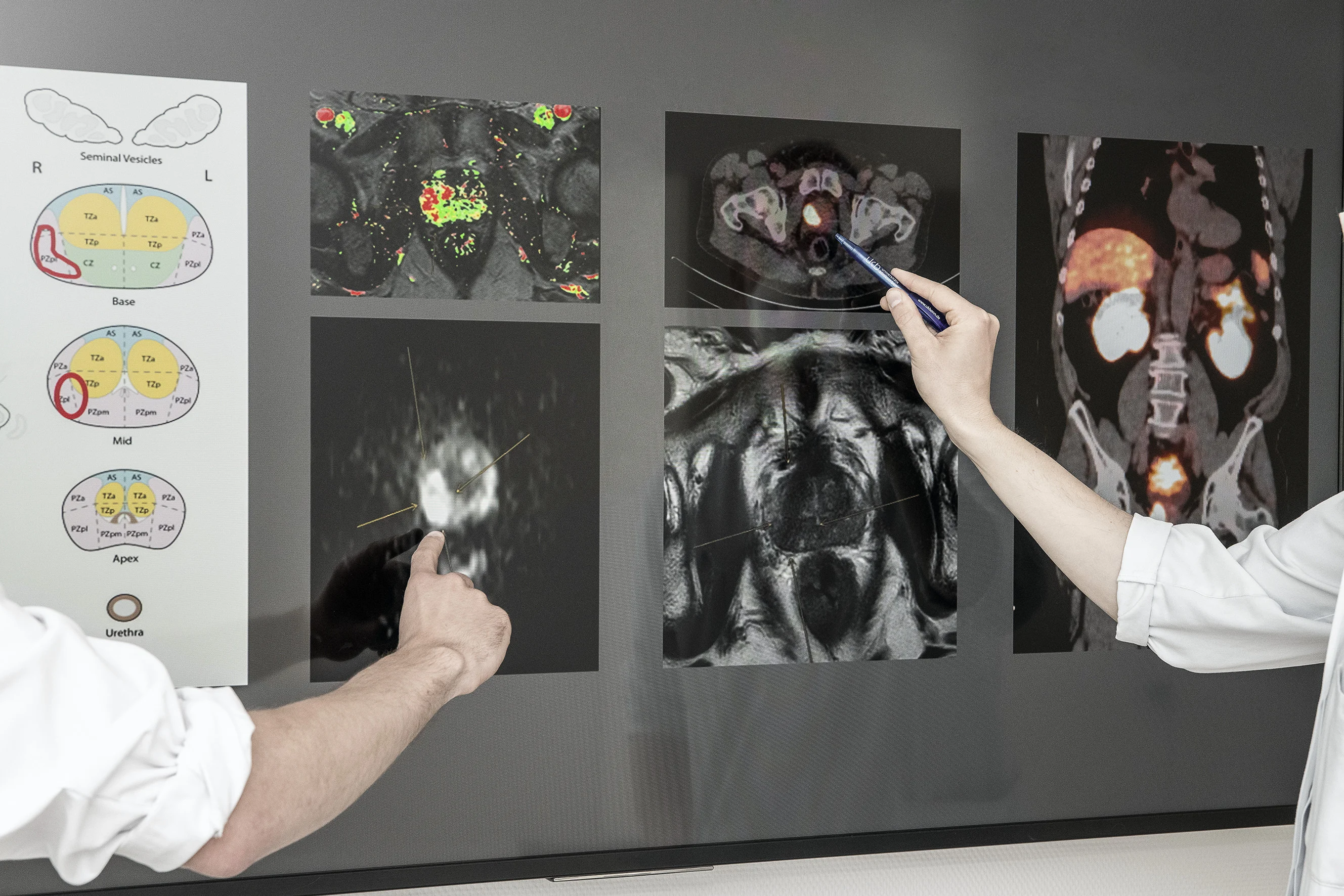 Interdisziplinäre Falldiskussion mittels bildgebender Verfahren bei Verdacht auf Prostatakrebs: