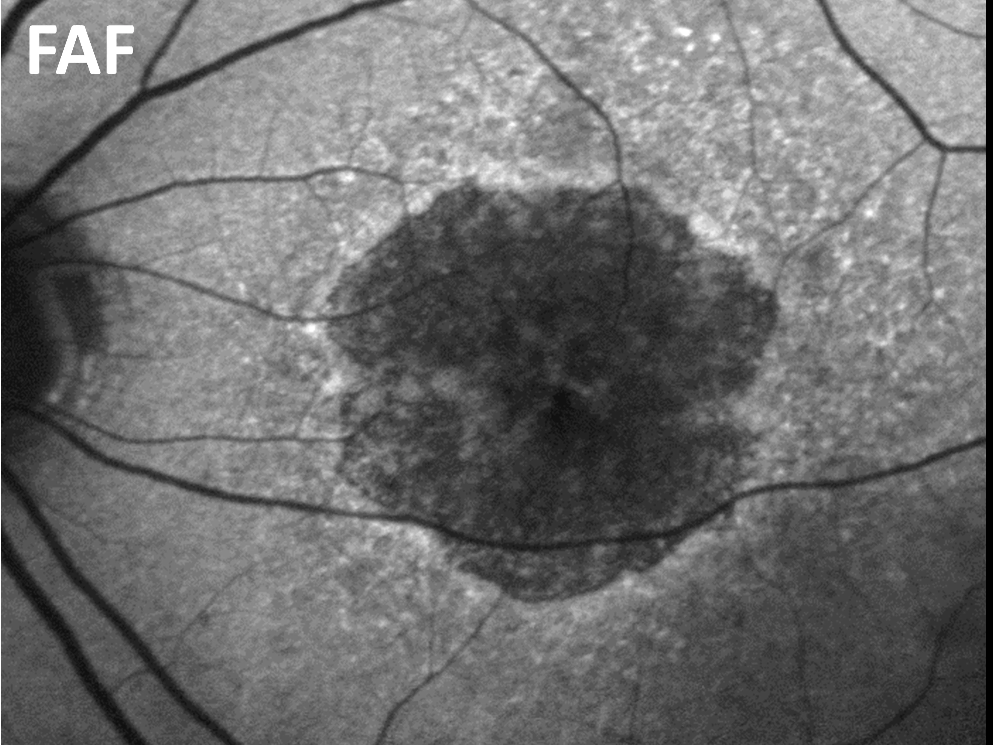 Fundus-Autofluoreszenz (FAF):