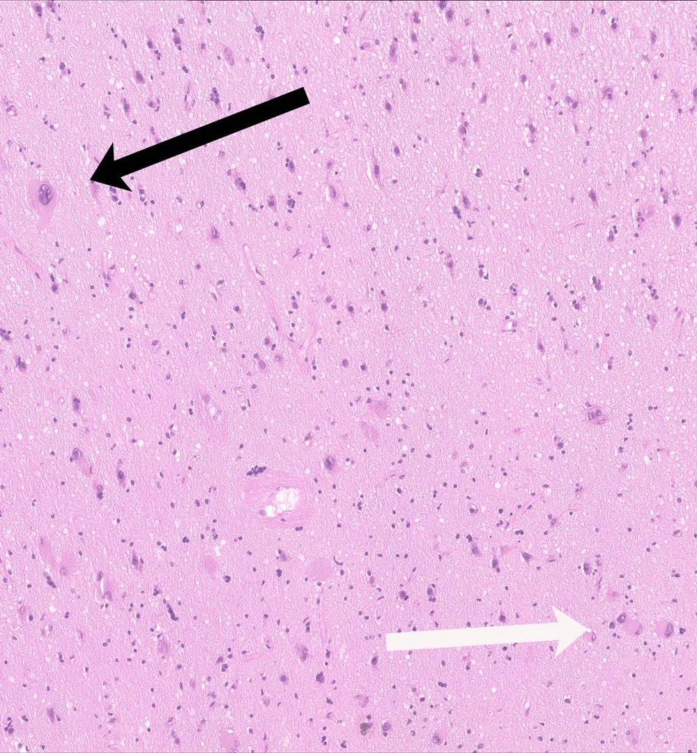 Biopsiepräparat eines Epilepsie-chirurgischen Eingriffs