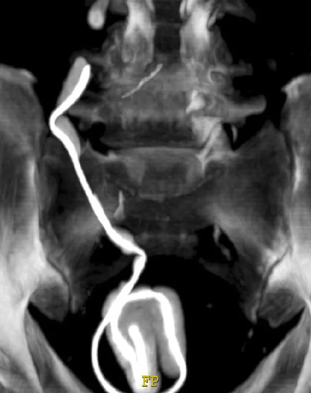 Bild Diamantähnliche Schichten halten Implantate sauber