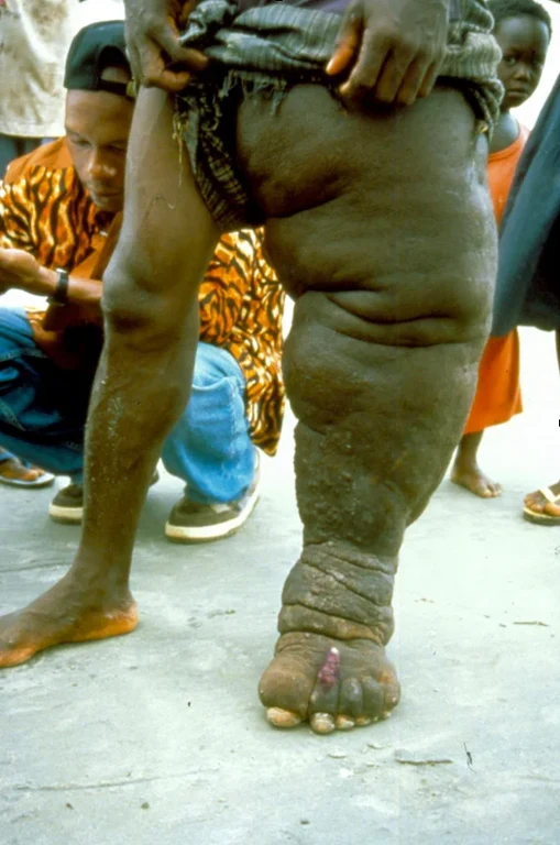 Beim Elefantenmann-Syndrom (Elephantiasis)