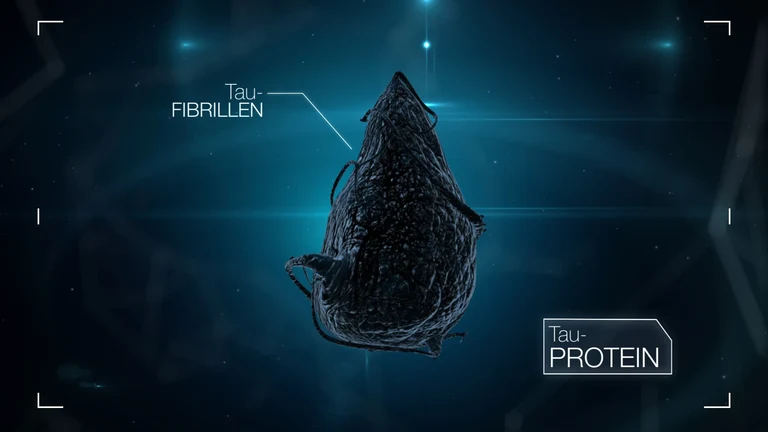 Charakteristisch für die Alzheimer-Krankheit: