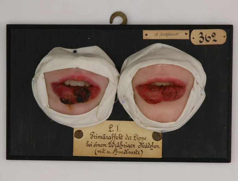 Das Aktuelle Objekt aus der Bonner Moulagen-Sammlung