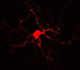 Im Gewebe von Patienten mit Schläfenlappen-Epilepsie