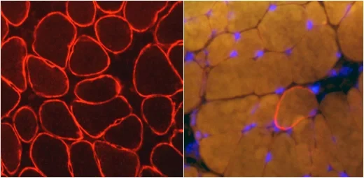 Die Muskeldystrophie vom Typ Duchenne: