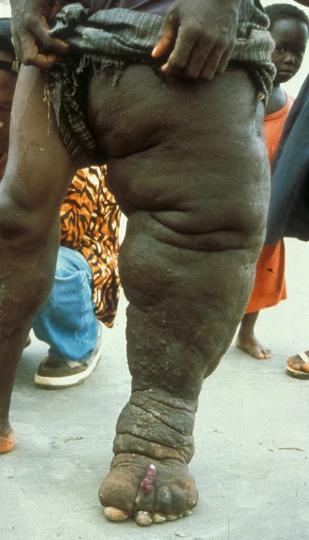 Elefantiasis.jpg