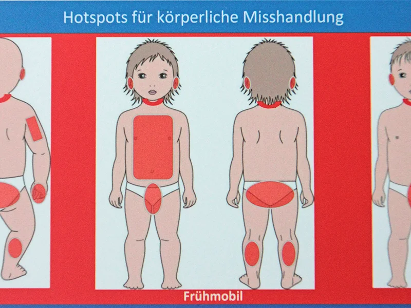 Kinderschutz-Leitlinie – ein blauer Fleck kann Hinweis auf eine Misshandlung sein: