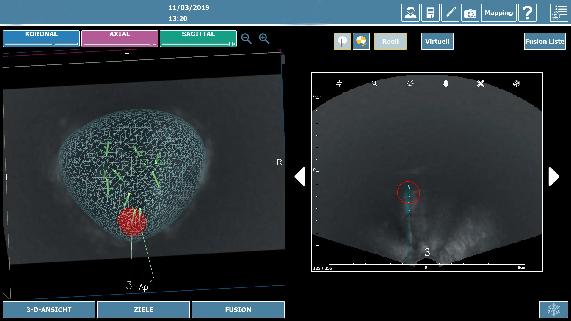 Neuartiges MRT-gestütztes Ultraschallsystem zur exakteren Prostatabiospie: