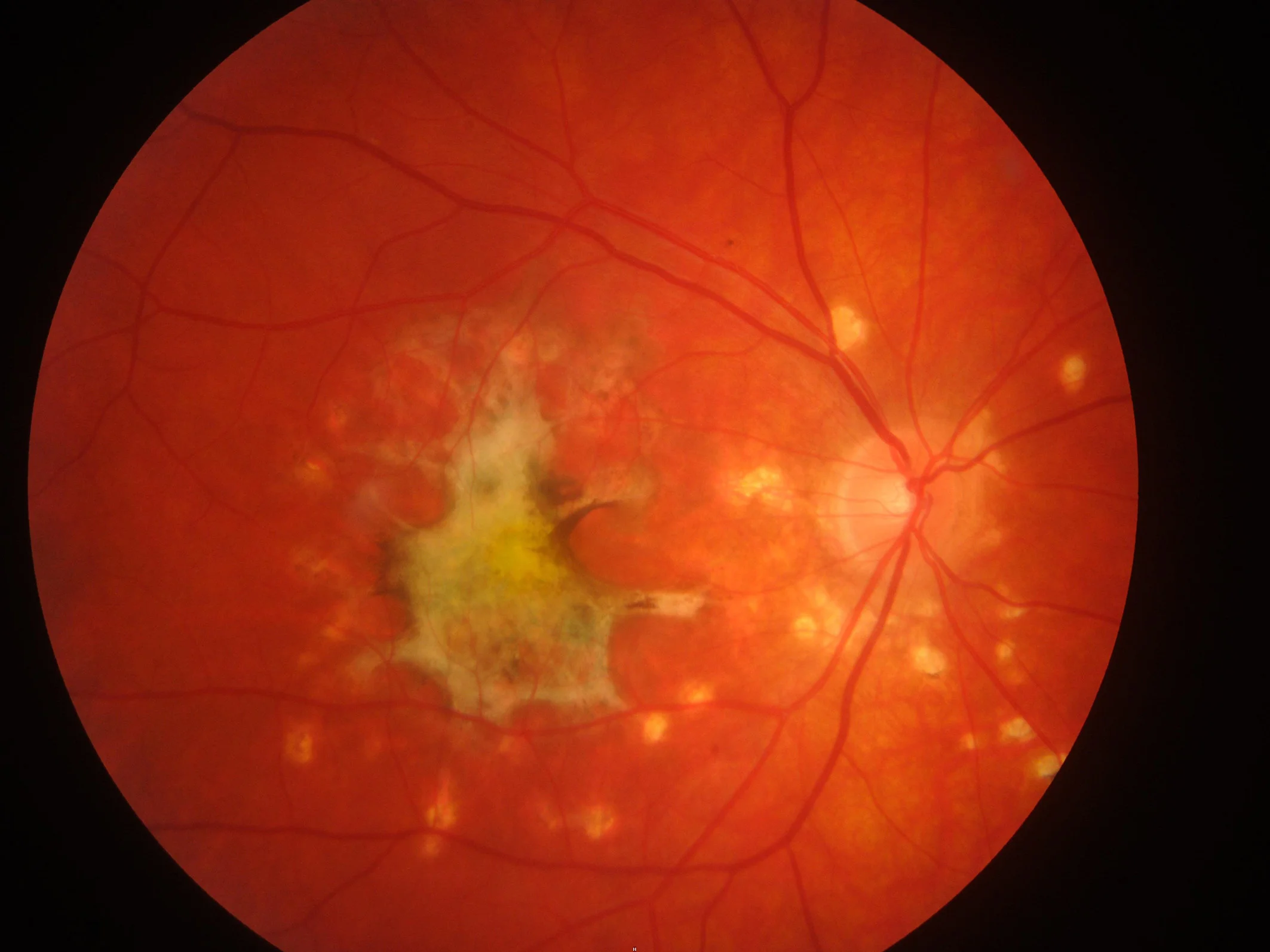 Foto des hinteren Augenabschnittes eines Patienten mit chronischer Entzündung der Aderhaut: