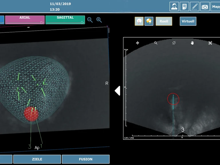 Neuartiges MRT-gestütztes Ultraschallsystem zur exakteren Prostatabiospie am Universitätsklinikum Bonn: