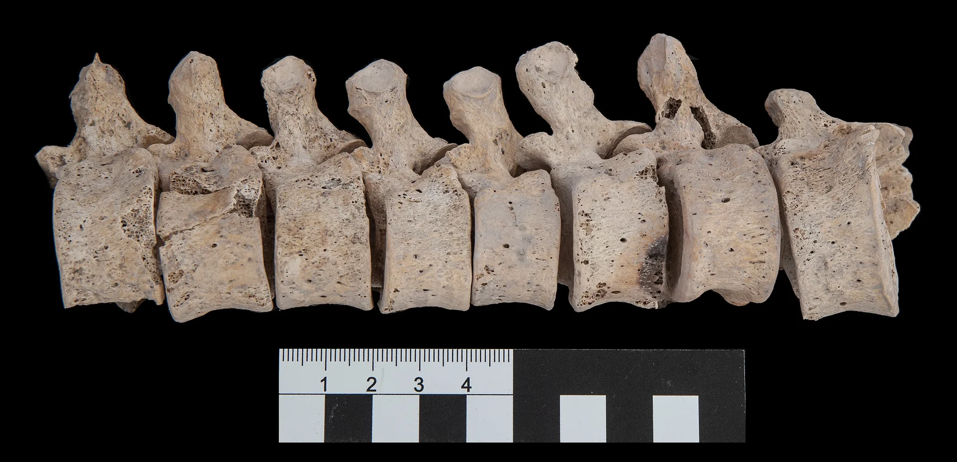 Brandspuren an den Lendenwirbeln