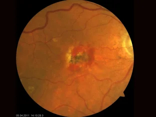 Aufnahme der  Netzhaut