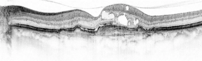 Optische Kohärenztomographie