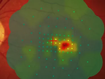 Funktionsuntersuchung mittels Mikroperimetrie