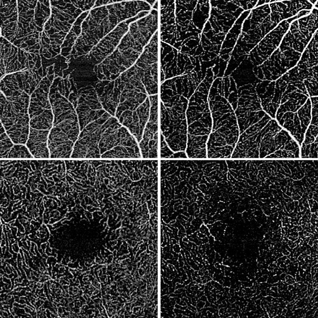Optical coherence tomography angiography showing ocular vascular perfusion in intermediate uveitis: