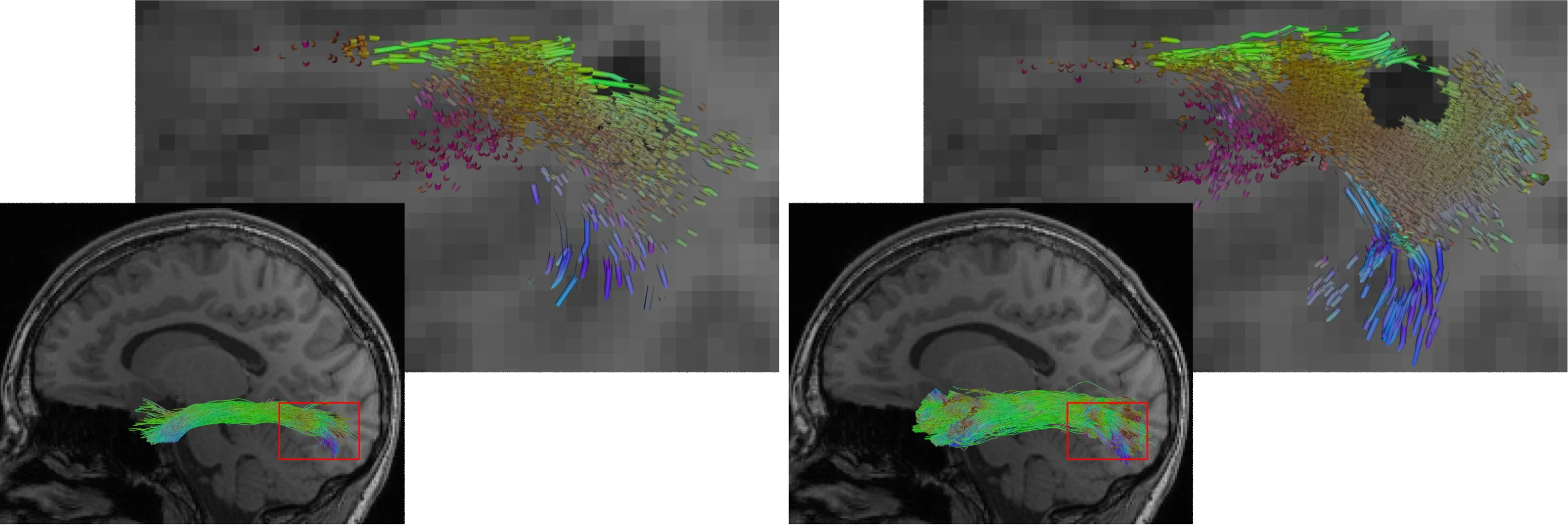 AI Enhances Brain Imaging