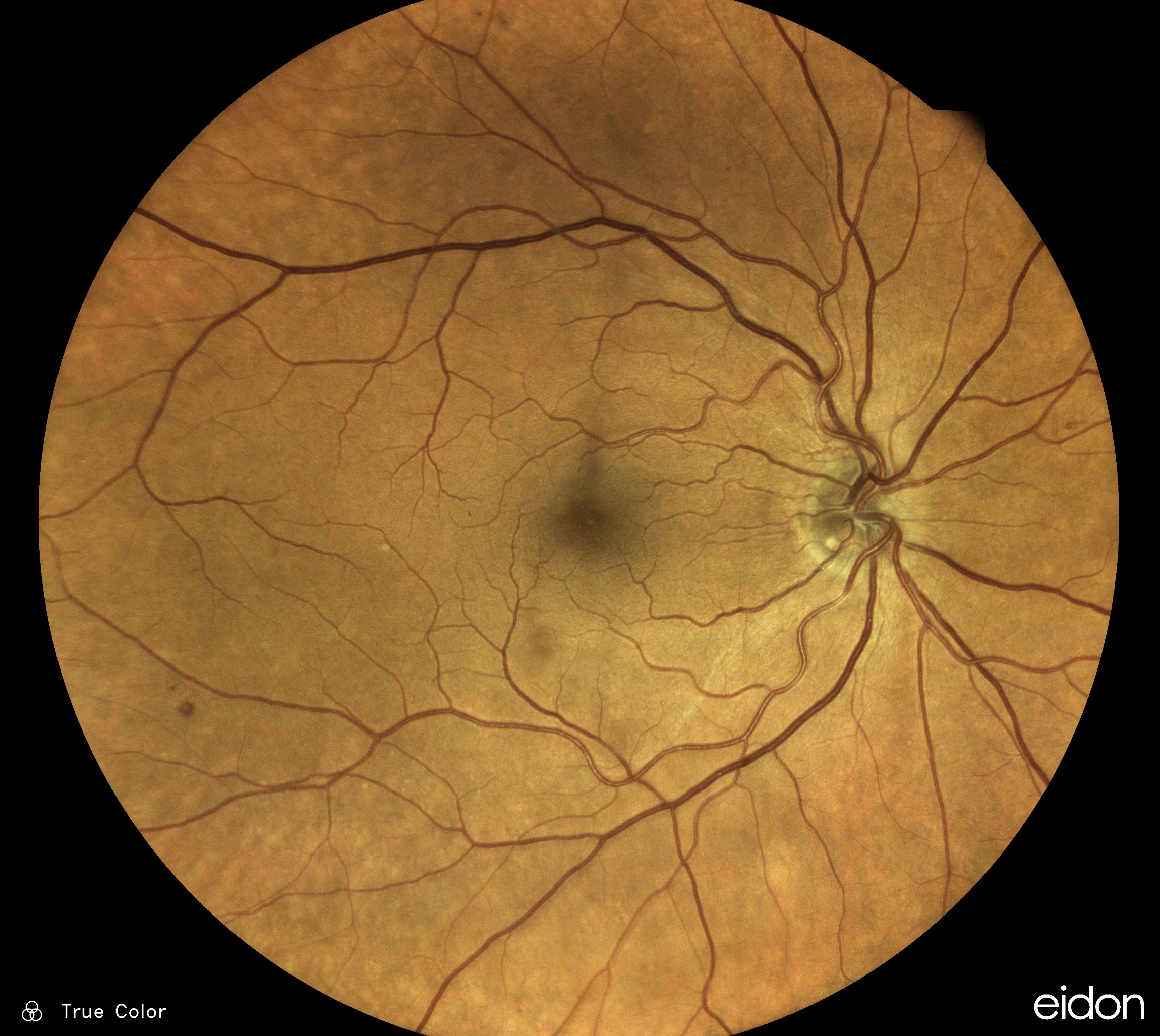 Eye provides clues to insidious vascular disease