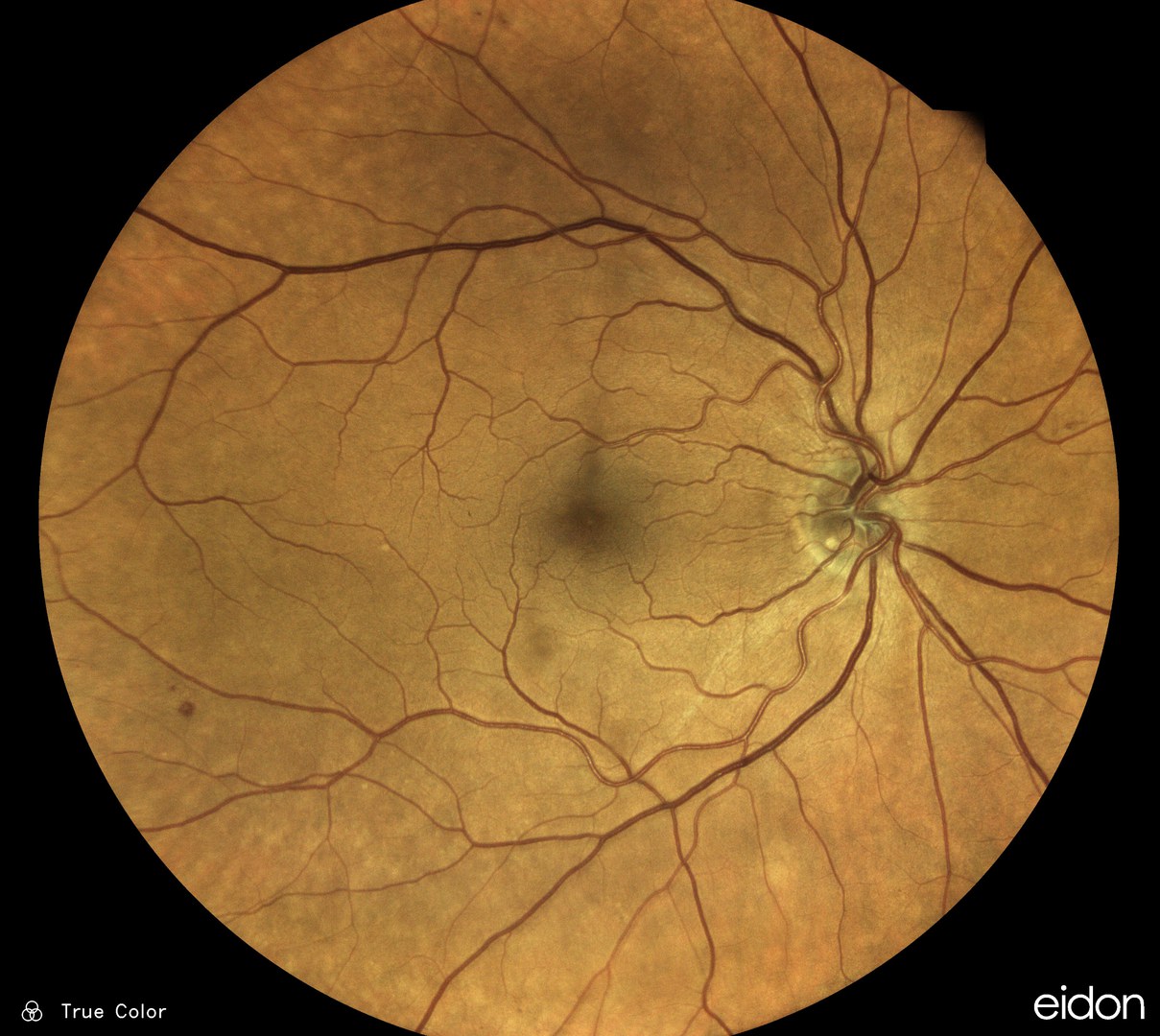 The fundus of the human eye is well perfused.