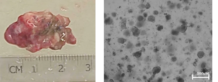 Creating Personalized Cancer Treatments Using “Mini-Tumors” and a Digital Twin