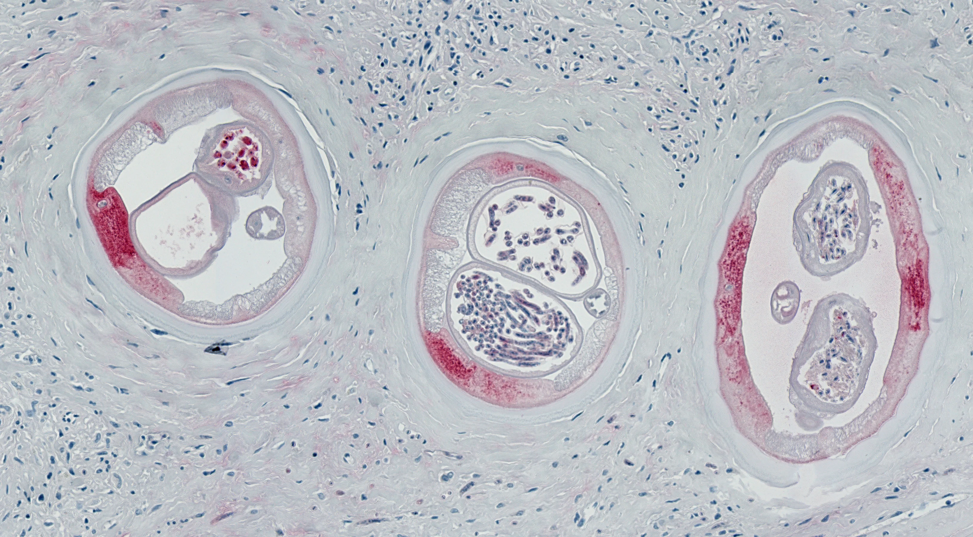 Funding in the millions to combat river blindness