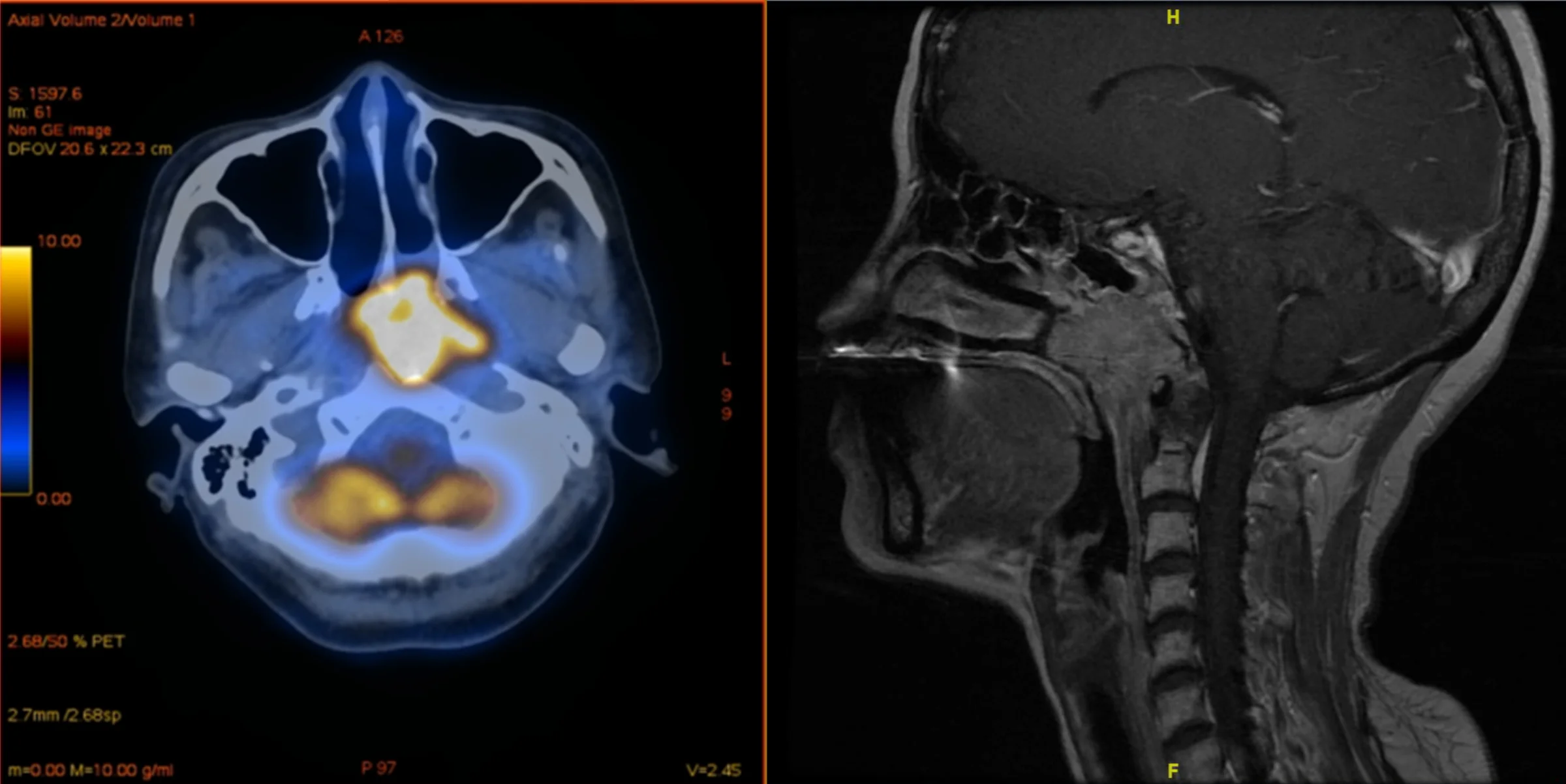 Covid vaccination improves effectiveness of cancer treatment
