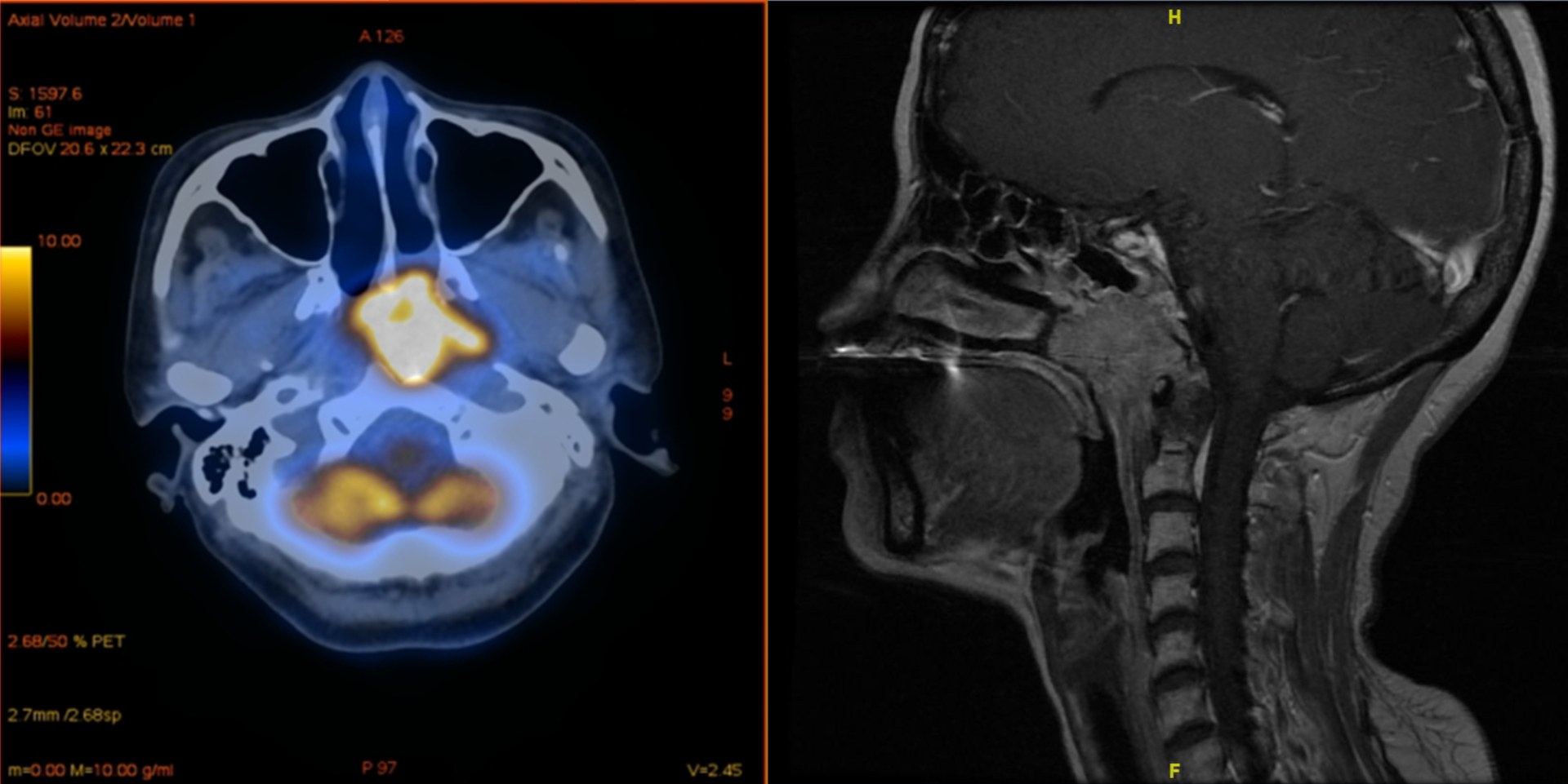 Nasopharyngeal tumors (highlighted in yellow)