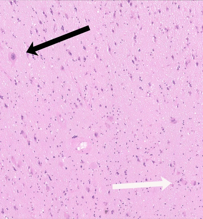 Biopsy slide from epilepsy surgery