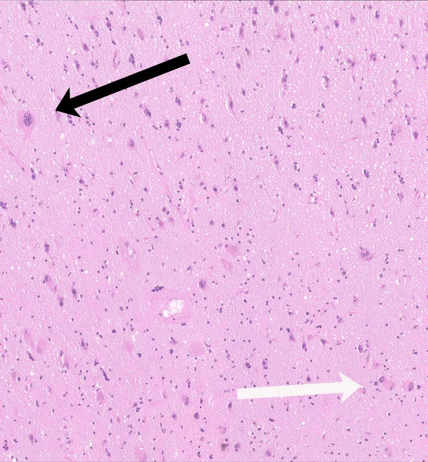 Biopsy slide from epilepsy surgery
