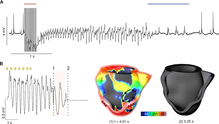 A: Optogenetic defibrillation (blue bar)